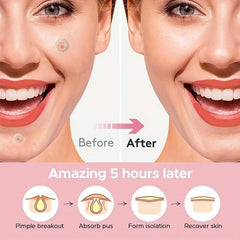 Hydrocolloid Acne Pimple Patch Tea Tree Facial Sticker