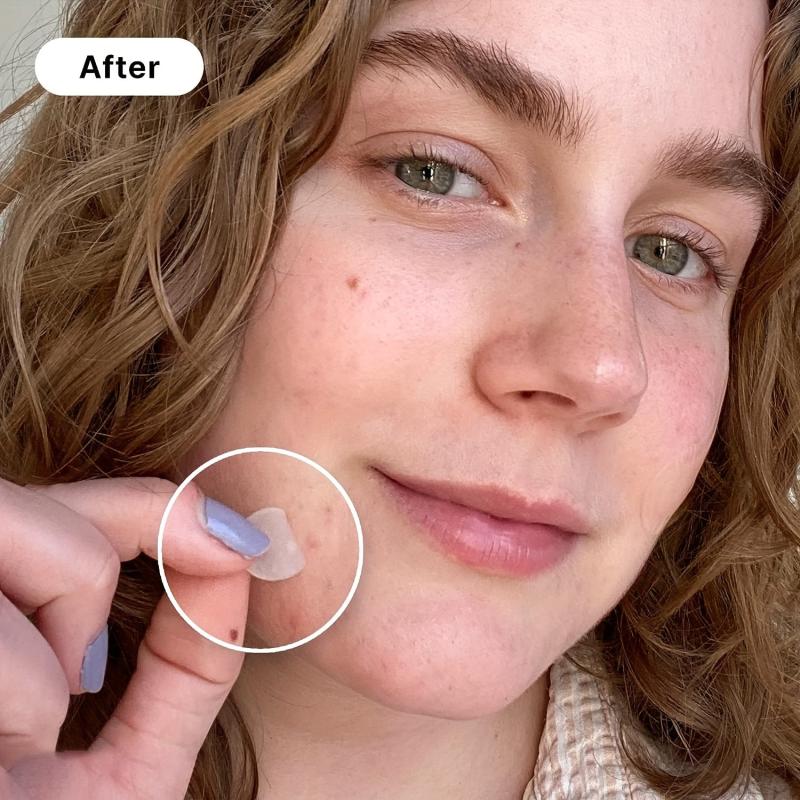 180 540pcs Acne Patches Pimple Patch Hydrocolloid Sticker for Skin Care