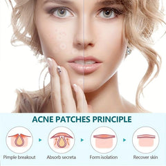 144 Pcs Pimple Patches Hydrocolloid Acne Cover Patches Spot Stickers