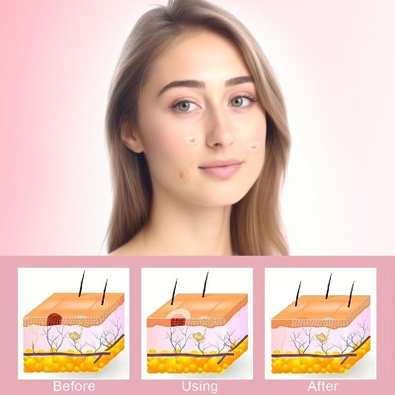 Hydrocolloid Acne Patches 360pcs, Daily Skin Care for Pimples and Blemishes