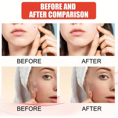 Acne Pimple Patch for Zits and Blemishes Spot Stickers