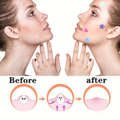 Colorful Hydrocolloid Acne Patch Acne Stickers For Women's Face Skin