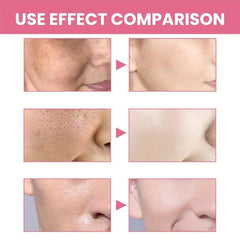 Facial Enzyme Cleansing Powder - Spots Acne Pores - 5pcs