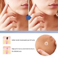 Hydrocolloid Acne Patches for Face - 48pcs Pimple Patch & Acne Stickers