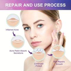 Acne Pimple Patch Mild Non Irritating Spot Stickers Face Skin Acne Remover