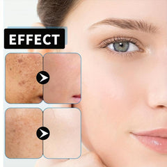 Age Spot Reducing Freckle Cream
