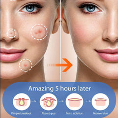 Acne Cover Patch Hydrocolloid Pimple Patch Zits Blemishes Spot Stickers
