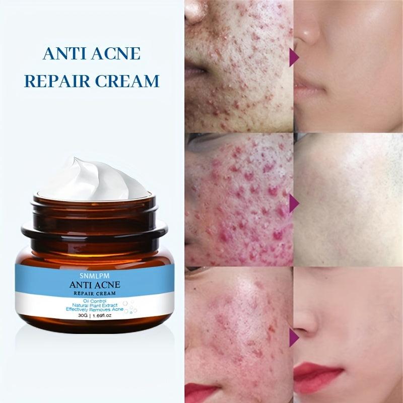 Acne Marks Scars Removal Repair Cream