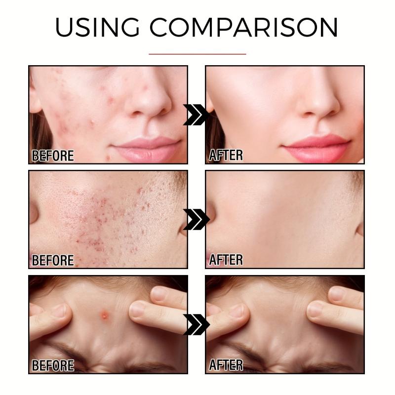 24 Pcs Acne Pimple Patch For Blemishes And Zits Cover Spot Stickers