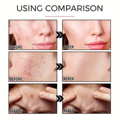 24 Pcs Acne Pimple Patch For Blemishes And Zits Cover Spot Stickers