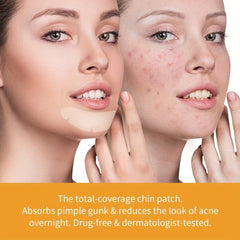 Hydrocolloid Acne Pimple Patch - Acne Cleansing Patch