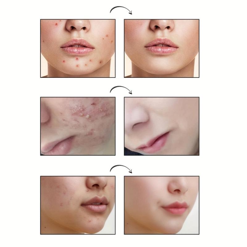 Hydrocolloid Acne Pimple Patches for Face Skin