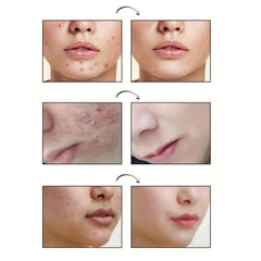 Hydrocolloid Acne Pimple Patches for Face Skin