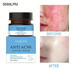 Natural Face Cream for Acne Marks and Pits - Skin Repair Formula