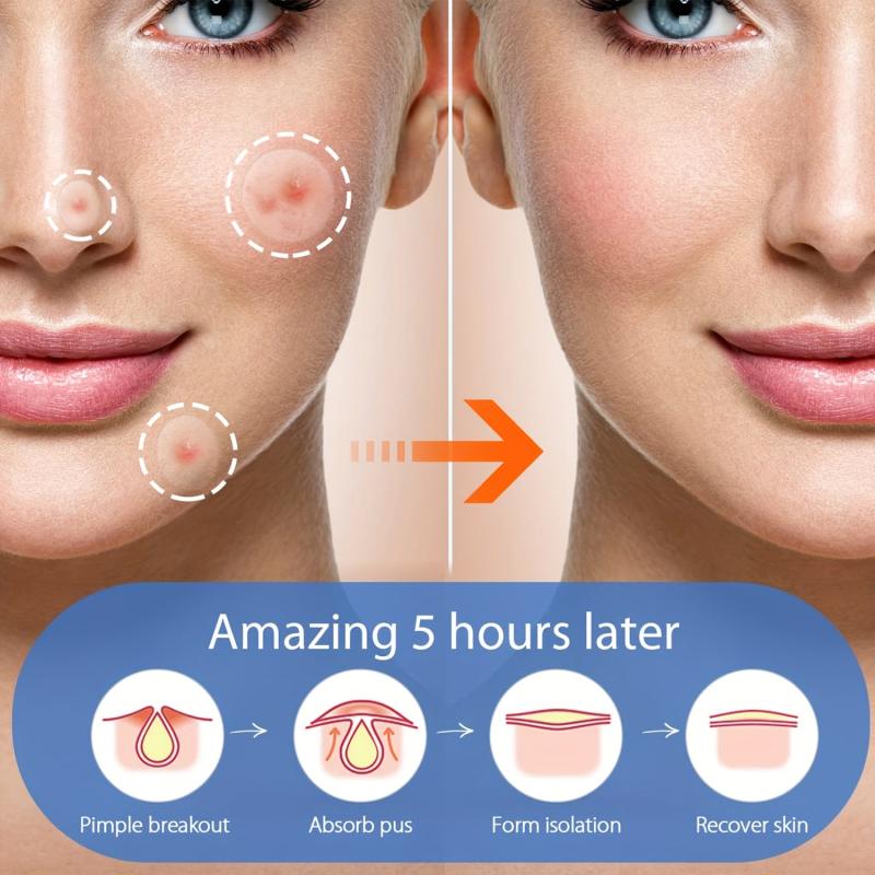Hydrocolloid Acne Pimple Patches - Cover Zits and Blemishes