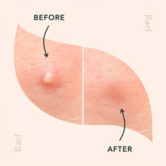 144 Ct Acne Pimple Patch Hydrocolloid Zit Patch Tea Tree Blemish Cover