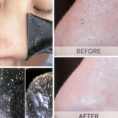Blackhead Nose Strips & Spot Stickers Set - Clear Skin