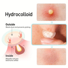 Acne Cover Patch Hydrocolloid Pimple Zit Blemish Stickers