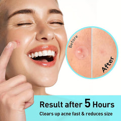 Acne Cover Patch Hydrocolloid Pimple Zit Blemish Stickers