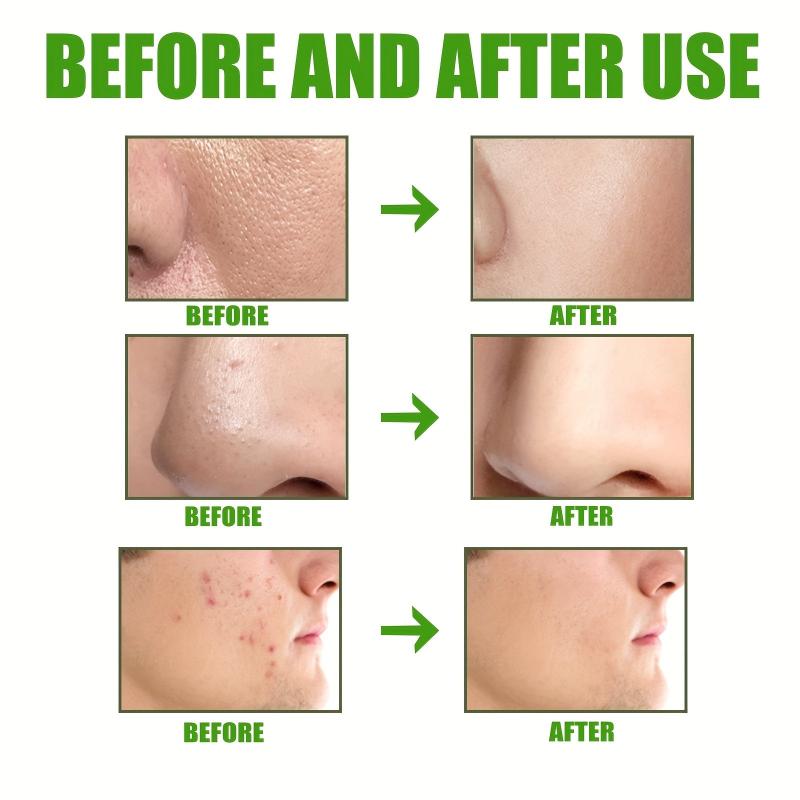 Mild Amino Acid Mask Acne Removing Blackheads Facial Clay Mask
