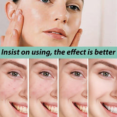 Acne Ointment w/Salicylic & Azelaic Acid 30ml