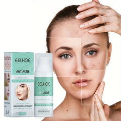 Acne Ointment w/Salicylic & Azelaic Acid 30ml