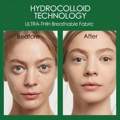 10pcs Invisible Acne Patch - Makeup Fri