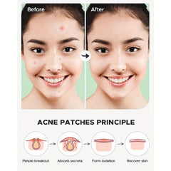 36pcs Acne And Spot Patches - Acne Pimple Patch for Daily Skin Care