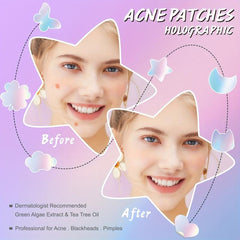 Acne Pimple Patch for Zits and Blemishes - Spot Stickers - Non Irritating