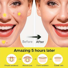 Heart & Star Acne Patch Set Hydrocolloid Cover Zit Dots Tea Tree
