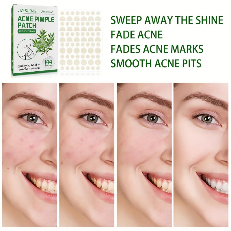 Acne Pimple Patch Vegan Friendly 144 Pcs