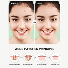 Acne Patches Hydrocolloid Acne Pimple Patch For Covering Zits And Blemishes