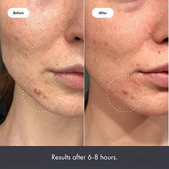 Star Shaped Acne Patches Hydrocolloid Absorbent and Gentle