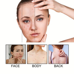 60pcs Colorful Acne Patches Hydrocolloid Spots Blemishes Cover Pimples Zits