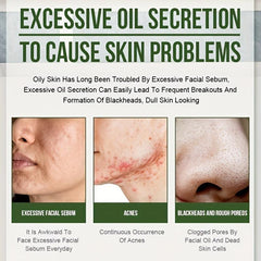 Acne Pit Repair Cream Fade Red Swollen Acne Scars