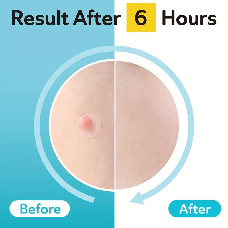Acne Patches Hydrocolloid Pimple Patch Zits Blemishes Spot Stickers