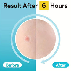 Acne Patches Hydrocolloid Pimple Patch Zits Blemishes Spot Stickers