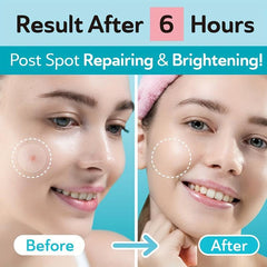 Acne Patches Hydrocolloid Pimple Patch Zits Blemishes Spot Stickers