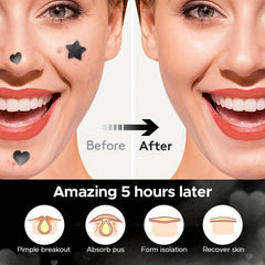 Star Shaped Acne Patch, Hydrocolloid Pimple Cover