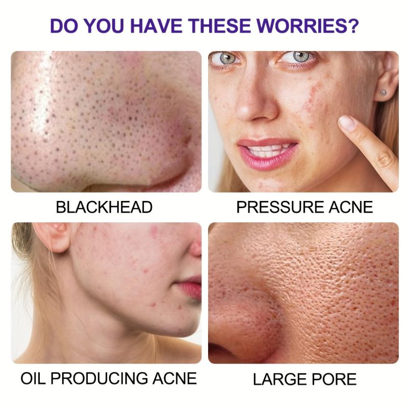 6 Charcoal Pore Strips for Blackhead Removal on Oily Skin