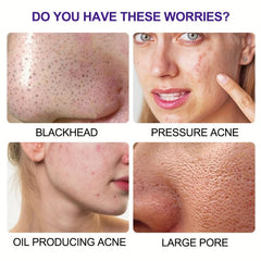 6 Charcoal Pore Strips for Blackhead Removal on Oily Skin