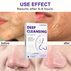 6 Charcoal Pore Strips for Blackhead Removal on Oily Skin