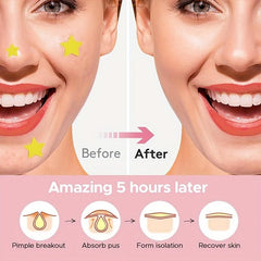 224pcs Acne Patch Pimple Cover Patch Hydrocolloid Acne Patches For Face