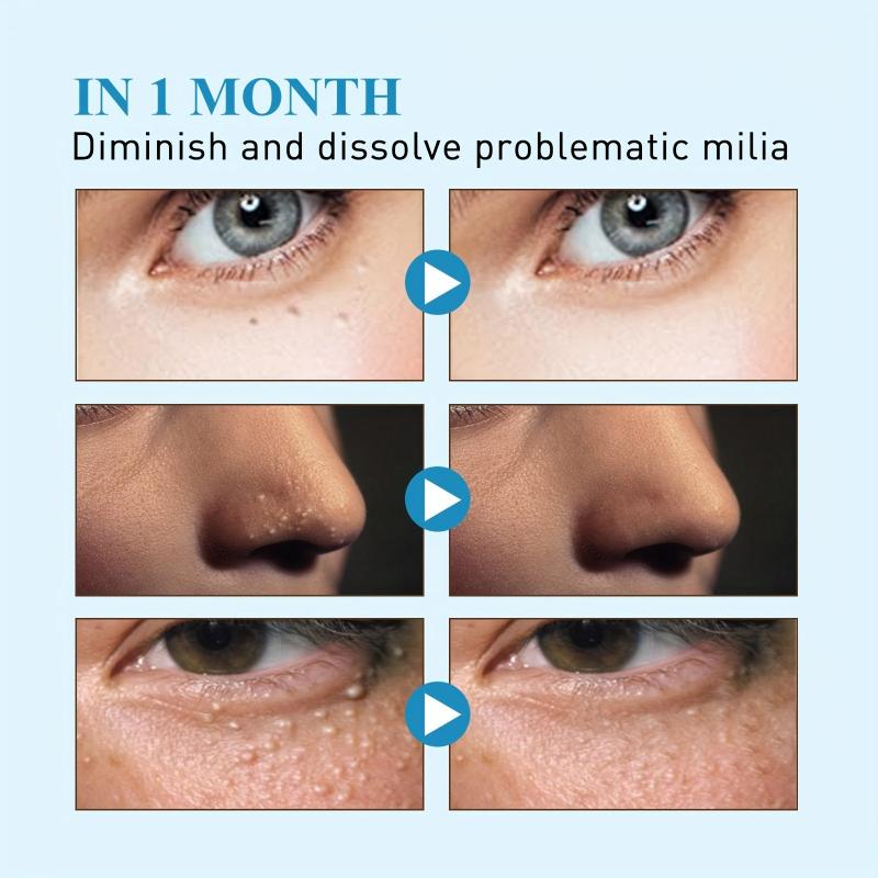 Milia Remover Patches 144Pcs Natural Ingredients Safe & Easy To Use