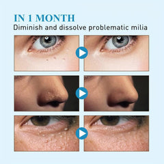 Milia Remover Patches 144Pcs Natural Ingredients Safe & Easy To Use