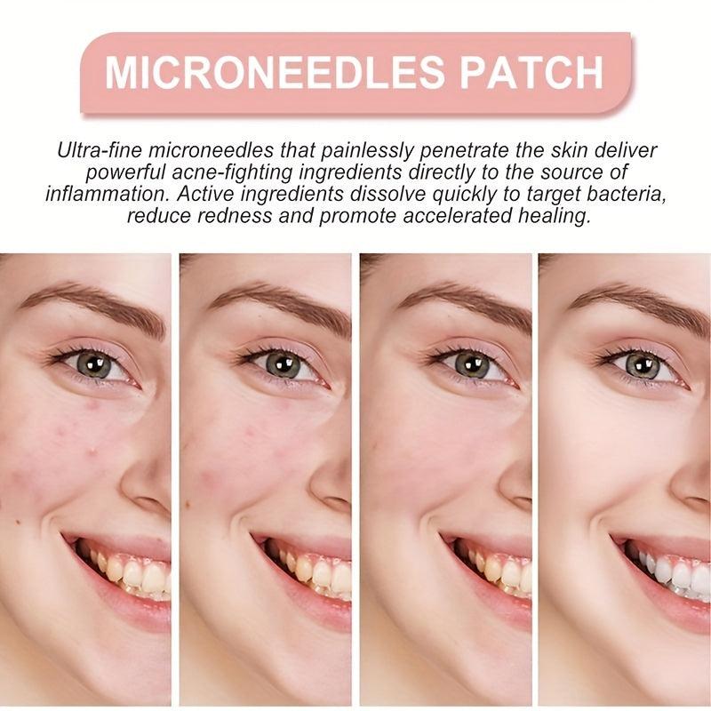 144 Pcs Face Patches Microneedles Invisible Acne Removal Patch Blemish Stickers