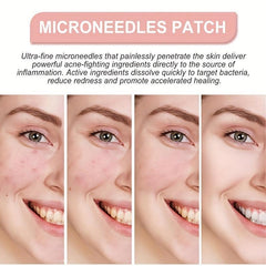 144 Pcs Face Patches Microneedles Invisible Acne Removal Patch Blemish Stickers