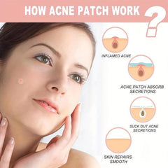 144 Pcs Face Patches Microneedles Invisible Acne Removal Patch Blemish Stickers