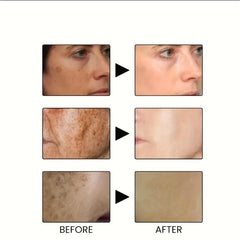 Hyperpigmentation Care Cream - Dark Spot Corrector for Face
