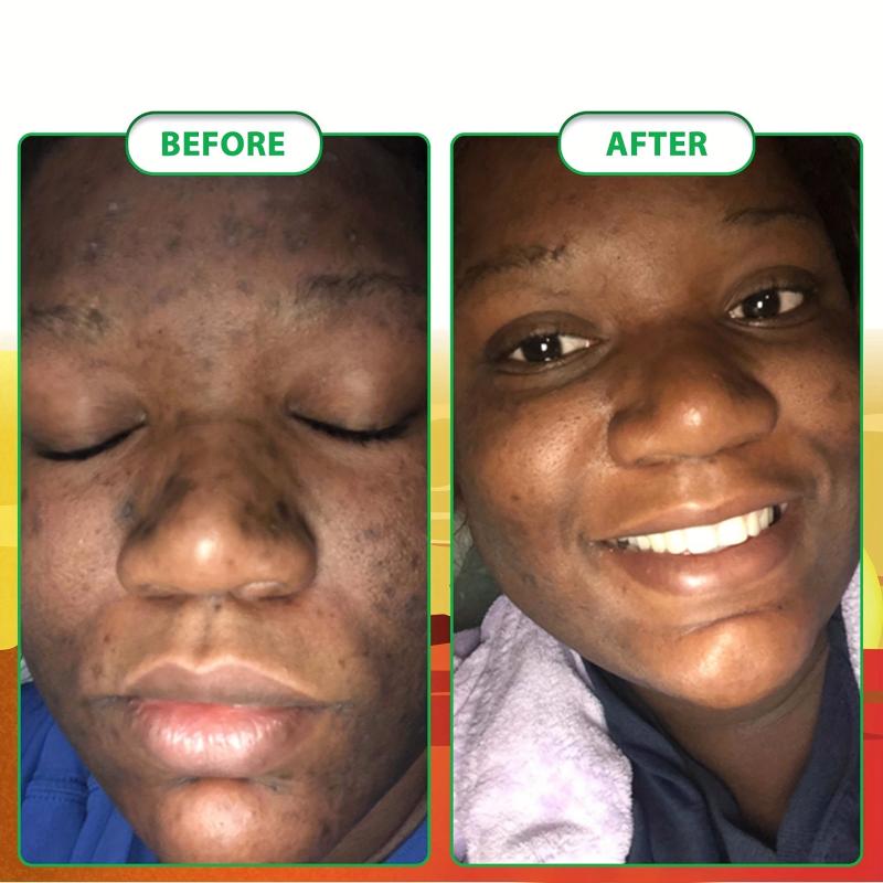 Organic African Soap for Acne & Dark Spots - 2 Bars x 65g Each